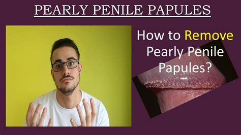 papule perlee penis|Pearly Penile Papules